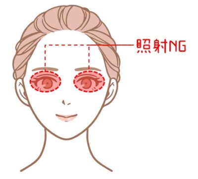 ケノン　照射NGエリア　図解